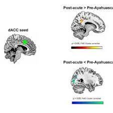 Brain Areas Showing Post Ayahuasca Statistically Significant Changes In Download Table