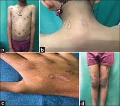 Image result for Linear Dermatitis