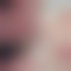 Image result for Human Bite