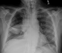 Under normal conditions, pleural fluid is secreted by the parietal pleural capillaries at a rate of 0.01 millilitre per kilogram weight per hour. Encysted Pleural Fluid Radiology Case Radiopaedia Org