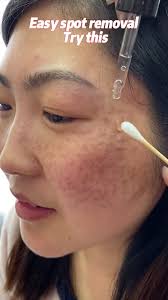 Qw Hyperpigmentation Solution... Try aobenz serum here!#freckles #spots