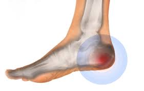 Image result for Calcaneal Apophysitis