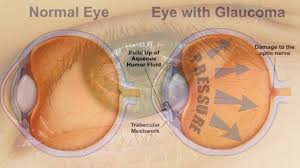 People who have a family history of glaucoma: à´— à´² à´• à´• à´® à´° à´— à´Žà´¨ à´¤ à´£ What Is Glaucoma Disease In Malayalam Which Type Of Food We Can Eat Youtube