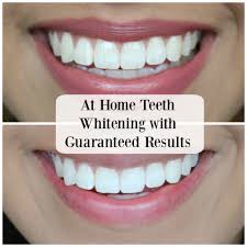 Pin On Teeth Whitening Before After Results