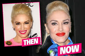A spokesperson for mya cosmetic surgery explains: What Blake Wants Gwen Stefani Has A Face Full Of Botox Top Docs Say