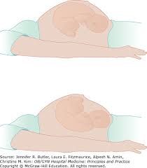 Image result for Manual Rotation in Occipitoposterior Presentation
