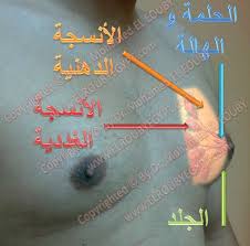 تضخم صدر الرجل Gynecomastia Adr