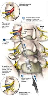 You may be referred to a physiotherapist or chiropractor to help restore restricted and painful facet joints. Sciatic Nerve Relief