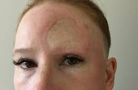 Mum Shares Graphic Surgery Recovery Pictures After Being Diagnosed With Really Rare Skin Cancer