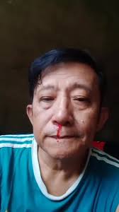 ....i know my condition...a sneeze will come to this my sinusitis infection  draw blood again.....bleed me not....XOXO