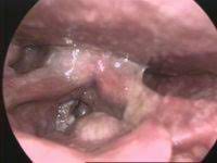 Hoarseness, trouble swallowing, and a visible lump in your neck are among the symptoms of. Laryngeal Cancer Wikipedia