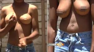 Brothers, Ridiculed For Having Breasts, Receive Breastectomies - TRPWL