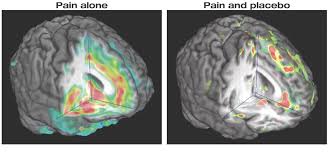Image result for Placebo Effect