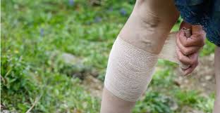 Image result for Lipodermatosclerosis