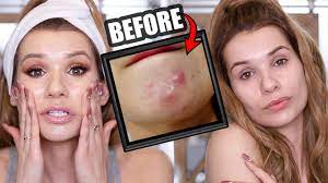 No deposit bonuses are a promotion given by online casinos to at… read more free casino games bonus no deposit How To Instantly Get Rid Of Acne Overnight Actually Works Youtube