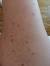 How To Get Rid Of Ingrown Hairs On Legs