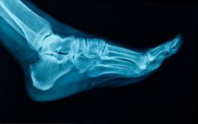 Image result for Ankle XRay