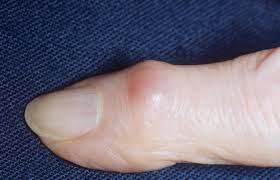 как вывести сухой мозоль со стержнем на пальце ноги Mozol Na Palce Ruki Vidy Raspolozhenie Prichiny Vozniknoveniya Lechenie