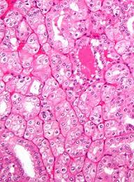 Most cancer researchers have assumed that the spread, or metastasis, of tumors typically occurs later in the disease process.the general idea has been that as tumors grow and. Renal Cell Carcinoma Wikipedia