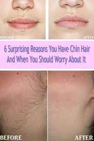 6 Surprising Reasons You Have Chin Hair And When You Should Worry About It Something Logical Chin Hair Chin Hair Removal Chin Hair Growth