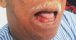 Jūs esat ieradušies uz šo lapu, jo tas, visticamāk, meklē: Double Tongue Appearance In Ludwig S Angina Nejm