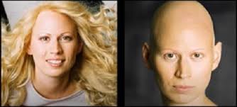 One of the most worrying aspects of starting any kind of cancer treatment is. Alopecia Areata And Dr Angela Christiano Hair Loss Cure 2020