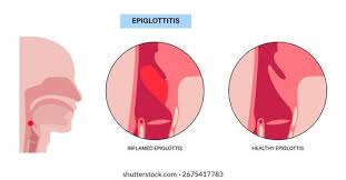 Image result for Epiglottitis
