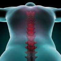 Dowager's hump (buffalo hump / neck hump) exercises Do This 30 Seconds Test To Check Your Posture Save Our Bones