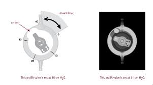 Determining Settings Of Programmable Vp Shunts Uw Emergency Radiology