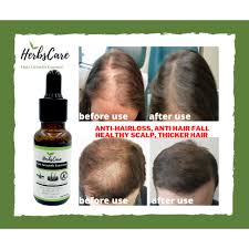 It not only reduces hair loss significantly but also stimulates new hair growth (5). Herbscare 100 All Natural Hair Growth Essence Hair Treatment Oil Anti Hair Loss Hair Fall Hair Care Shopee Philippines