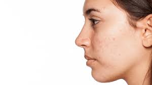 We'll work directly with you to formulate your own customized skincare solution. Will Acne Go Away As I Age