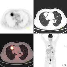Pet Ct Principles And Applications In Lung Cancer Management Intechopen