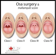 Sleep apnea is the cessation of breathing during sleep. Osa Surgery And Mallampati Score Health Education Sleep Disorders Surgery