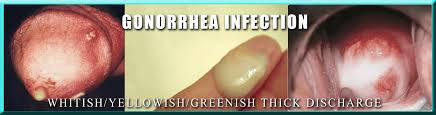 Signs and symptoms of gonorrhea may include: Gonorrhea Greenish Yellowish Painful Genital Secretion