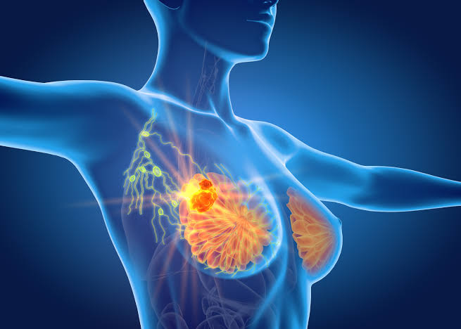 Diagnosed With Breast Cancer? Here's Why Doctors May Recommend Chemotherapy First