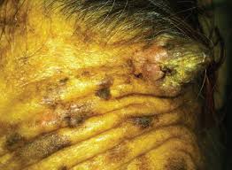 Image result for cornu cutaneum)