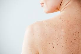 06.05.2021 · if your mole has an uneven border this can be a sign of change, and again this needs to be assessed by a skin cancer specialist. What Percentage Of Mole Removals Are Cancerous Eternal Dermatology Columbia Md