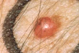 Mf can occur in people of any age, but most who get it are in their 50s or 60s. Firm Red Skin Lump Image Details Nci Visuals Online