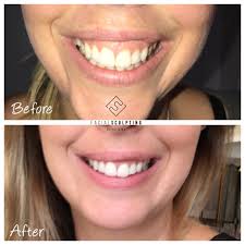 One way however is to see an orthodontist. Gummy Smile Facial Sculpting