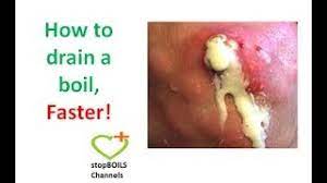 Once the boil and surrounding area are numb, the doctor will cut a small incision in the boil. Best Answer How Long Does It Take A Boil To Drain Once It Starts