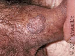 Image result for genital warts