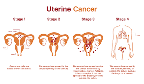 Both sides of my body were affected. Endometrial And Uterine Cancers Patient Care
