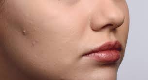 Garshick recommends reaching for vitamin a. The Best Minerals And Vitamins For Acne