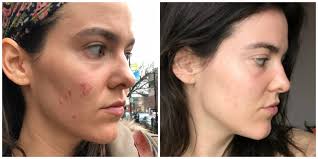 My Skincare Journey, Continued: How I Finally Stopped Picking My Face [Part  2]