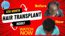 6th Month Hair Transplant Result / Best Hair Transplant Result ...