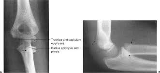 The Presence Of An Epiphyseal Line Indicates: Longitudinal Growth Is  Beginning, Appositional Growth Is Beginning, Longitudinal Growth Has Ended,  Appositional Growth Has Ended, Both Longitudinal And Appositional Growth Is  Beginning.