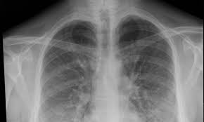 Image result for Pneumonia