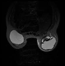 Dark, yellow, straw colored fluid tends to indicate that the rupture has extended over several months. Breast Implant Rupture Radiology Reference Article Radiopaedia Org