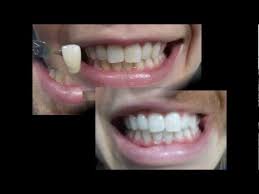 Well i've brought you along to gorgeous smiles dentistry in melbourne where i show you exactly (at times too much information) how it works thanks so much for tuning in, hit that subscribe button! Zoom Teeth Whitening Reviews Before And After Photos Youtube