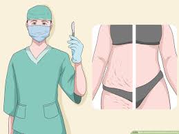 Maybe you would like to learn more about one of these? 3 Ways To Get Rid Of Stretch Marks At Home Wikihow